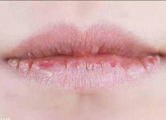 紋唇后嘴巴干燥怎么辦？南寧教紋繡的學(xué)校幫你解決