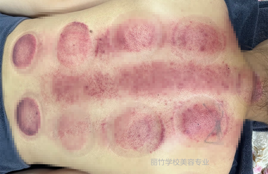 拔火罐的顏色代表什么？南寧美容美體專業(yè)實(shí)訓(xùn)