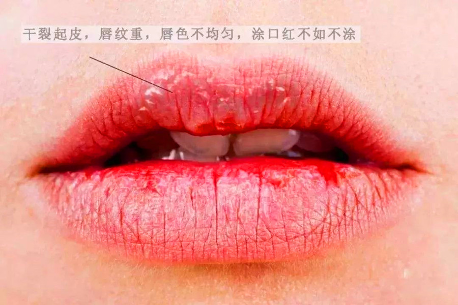廣西皮膚管理培訓(xùn)機(jī)構(gòu)：解決嘴唇干裂的急救方法